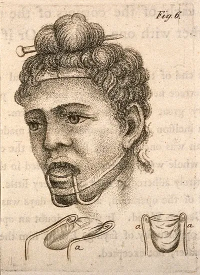 A diagram of a head illustrating a jaw and chin brace