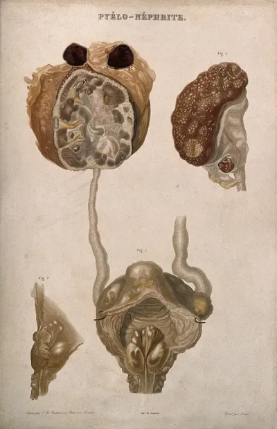 A disease causing inflammation of the kidneys and pelvis, numbered for key
