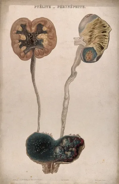 A disease causing inflammation of the kidneys and pelvis