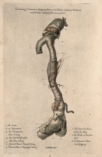 A diseased artery