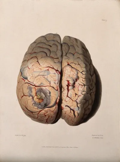 A diseased brain