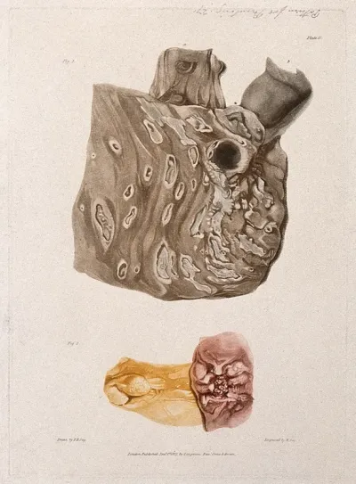 A diseased colon; and a section of diseased small intestine