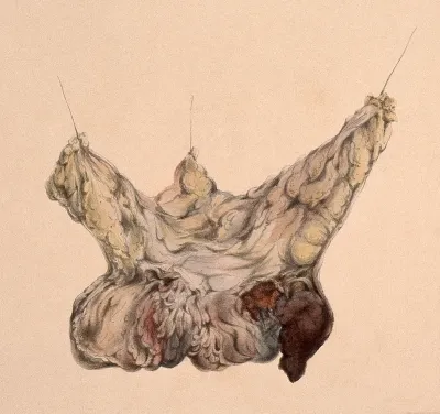 A diseased female breast
