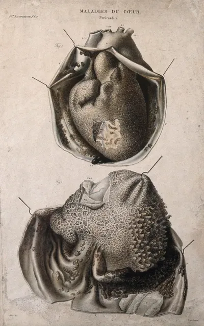 A diseased heart in two stages of dissection, numbered for key