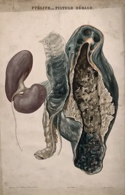 A diseased kidney