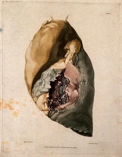 A diseased lung