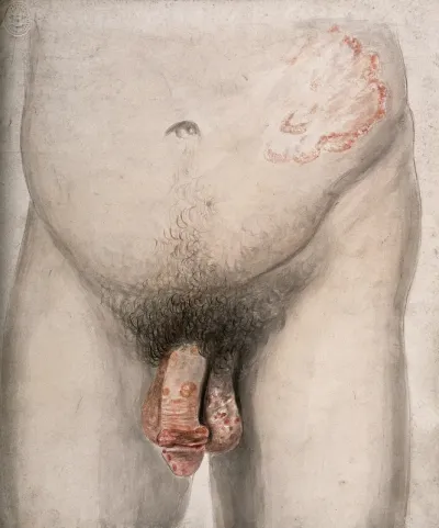 A diseased penis and abdomen of a man