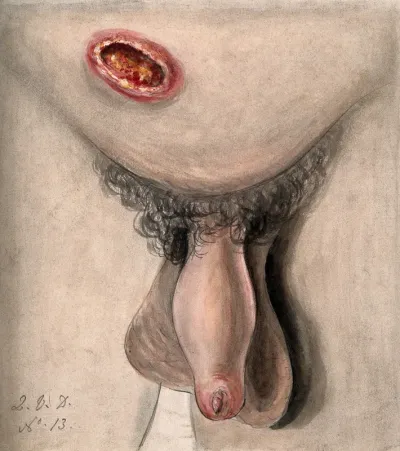 A diseased penis and lower abdomen showing symptoms of perforating phagedena