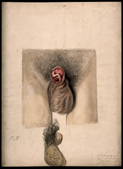 A diseased penis, showing symptoms of dry gangrene and sloughing phagedena