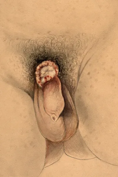 A diseased penis showing symptoms of gangrenous chancre of the pubis