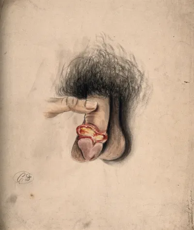 A diseased penis, showing symptoms of inflammatory or moist gangrene