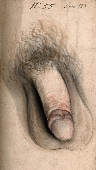 A diseased penis showing symptoms of paraphimosis