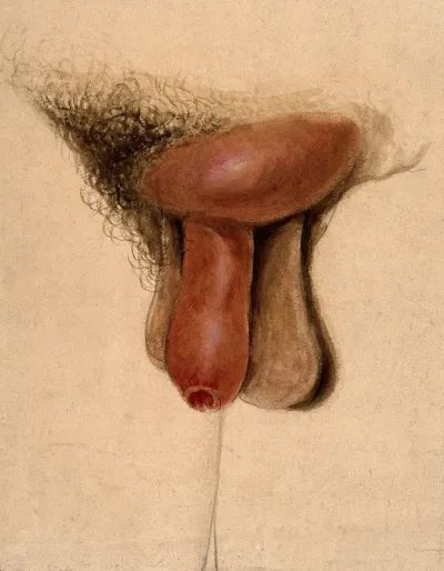 A diseased penis with a swelling on the pubis