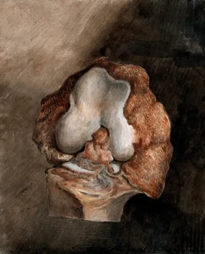 A diseased section of bone