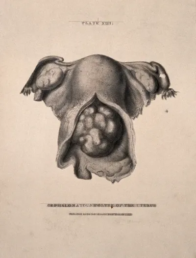 A diseased uterus, lettered for key