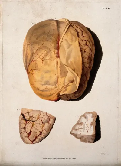 A dissected brain; and two sections of diseased brain