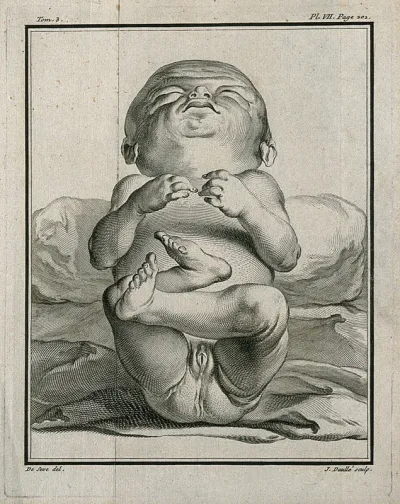 A female foetus of six inches in length with over-developed genitals