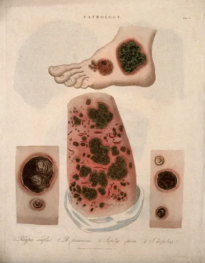 A foot with a skin disease; and three patches of skin showing types of skin disease