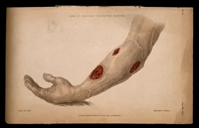 A forearm with three open wounds