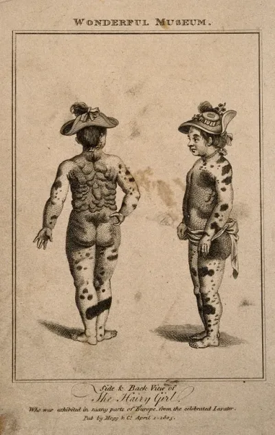 A girl suffering from a skin disease, identified as multiple fibroma: side and posterior view