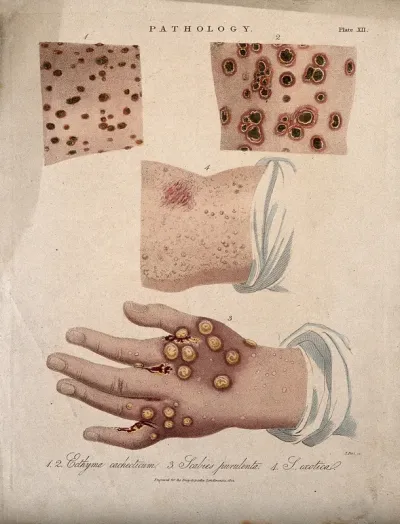 A hand with a skin disease; and three patches of skin showing types of skin disease