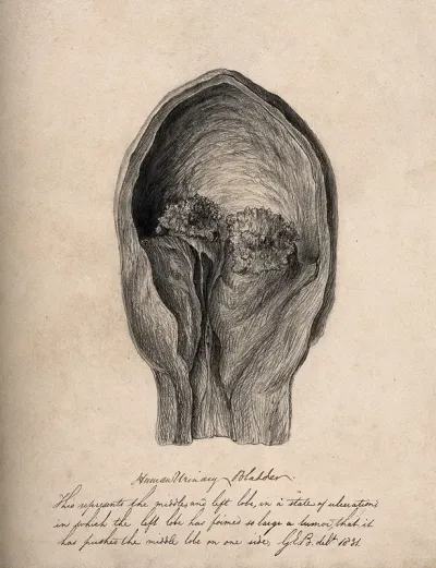 A human bladder with a tumour