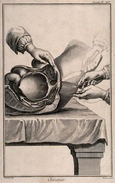 A lateral incision into the hypogastrium for removal of bladder stone
