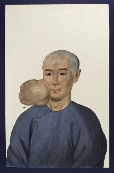 A man (Chang Achum?), facing front, with a tumour on the right side of his face