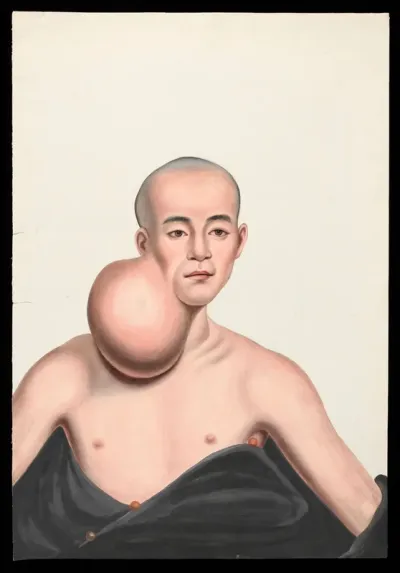 A man (Choo Yihleang), facing front, with a massive spherical tumour on the right side of his neck