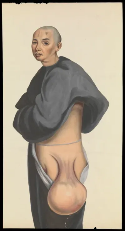 A man (Kwan Nanking) with a large pendent tumour hanging from his hip