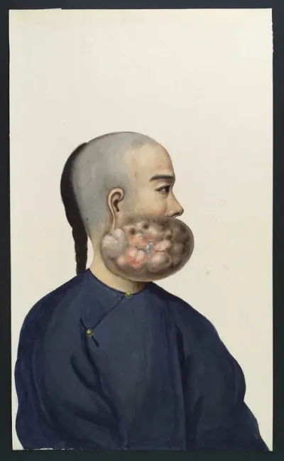 A man (Leang Ashing), in profile, with a tumour on the right side of his face