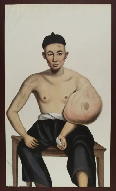 A man (Po Ashing) with a tumour on his left arm