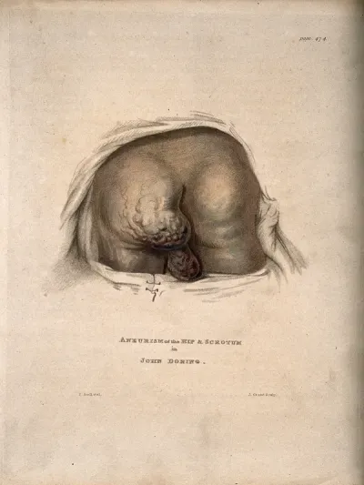 A man's bottom with an aneurism on the buttock and scrotum
