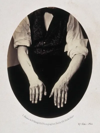 A man's hands, palms down, fingers closed, showing misshapen fingers