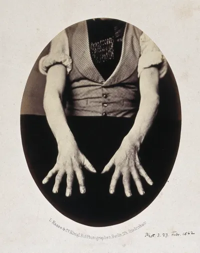 A man's hands, palms down, opened out and spread onto black cloth, showing misshapen fingers