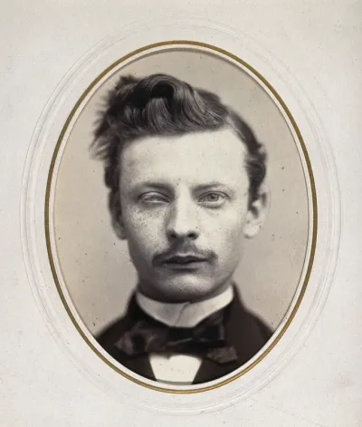 A man's head; his left eye is smaller than his right