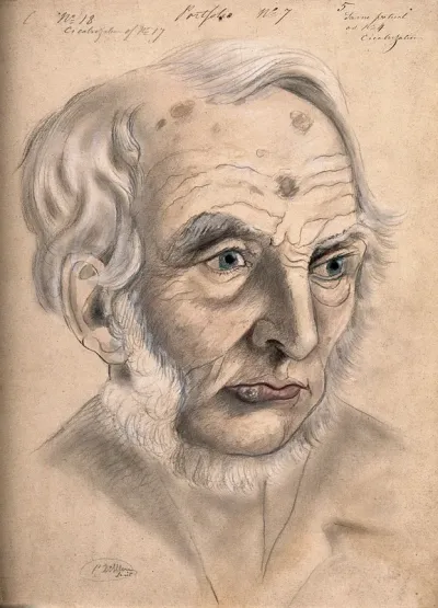A man suffering from chancre of the lip, displaying scar tissue on his lower lip, forehead and scalp, shown after treatment and following the process of cicatrization