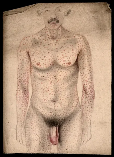 A man suffering from diseased genitals, with a rash of sores covering his body