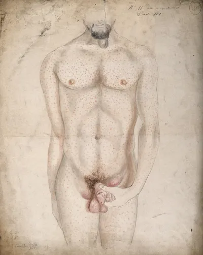 A man suffering from diseased genitals, with a swelling in the groin area and a rash of sores covering his entire body