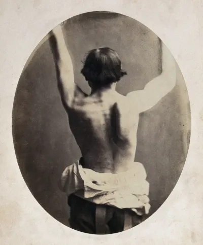 A man, viewed from the back, unclothed to his waist and raising his arms; with protuberance on right shoulder