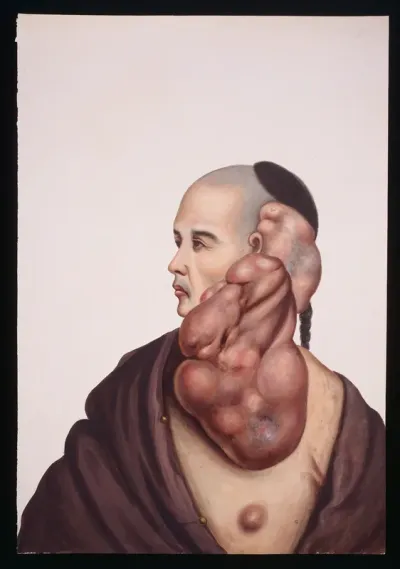 A man (Wan Wakae) with massive pendent tumours on the left side of his face