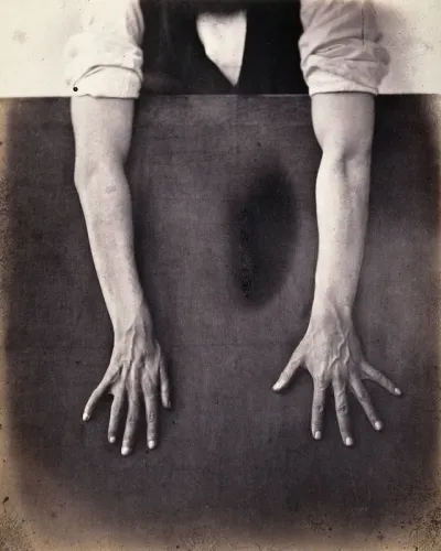 A man whose hands and forearms are exposed against a black background, fingers stretched, revealing less mobility in right hand