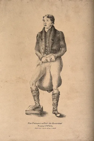 A man with a huge testicular tumour