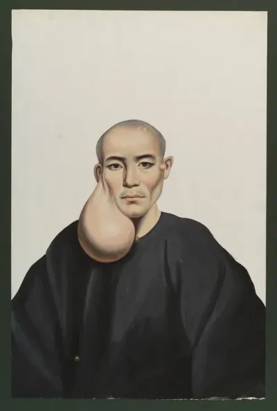A man with a pendent tumour below his right ear