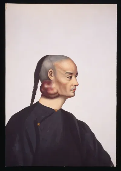A man with a tumour below and behind his right ear