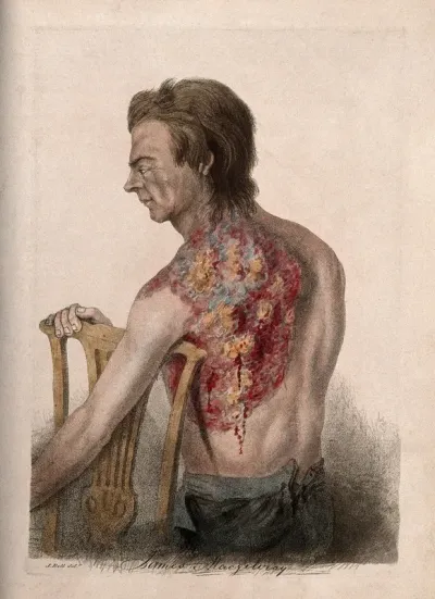 A man with a wounded back and shoulder leaning against a chair back