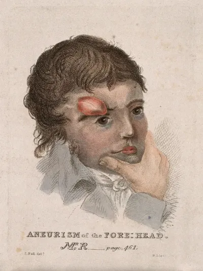A man with an aneurism on his forehead