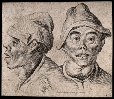 A man with goitre: front (left) and profile (right) views