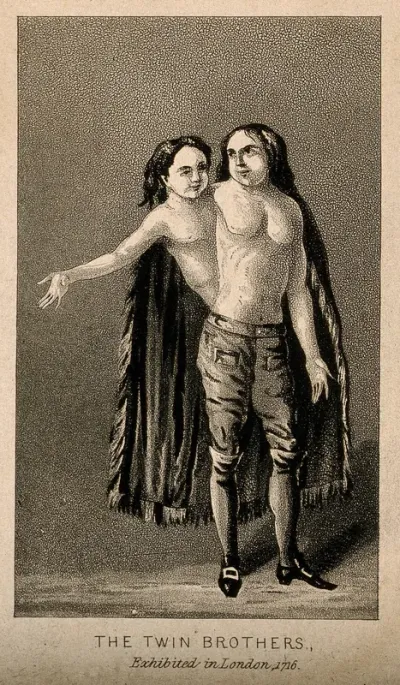A man with two heads and two trunks, 1716