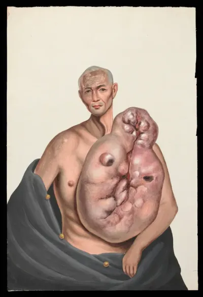 A man (Woo Kinshing), facing front, with a massive tumour on the left side of his trunk